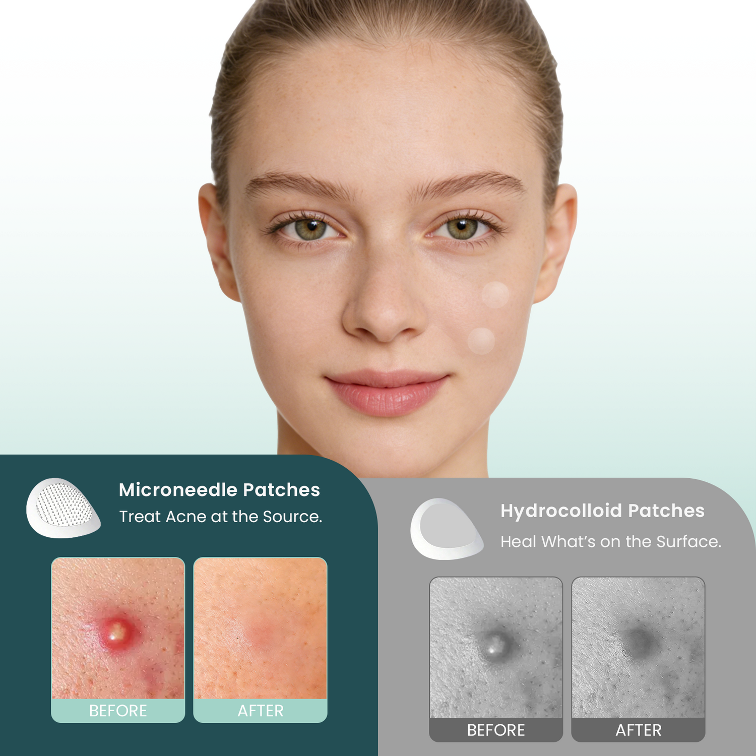 YOEYOU Micro-infusion Pimple Patches