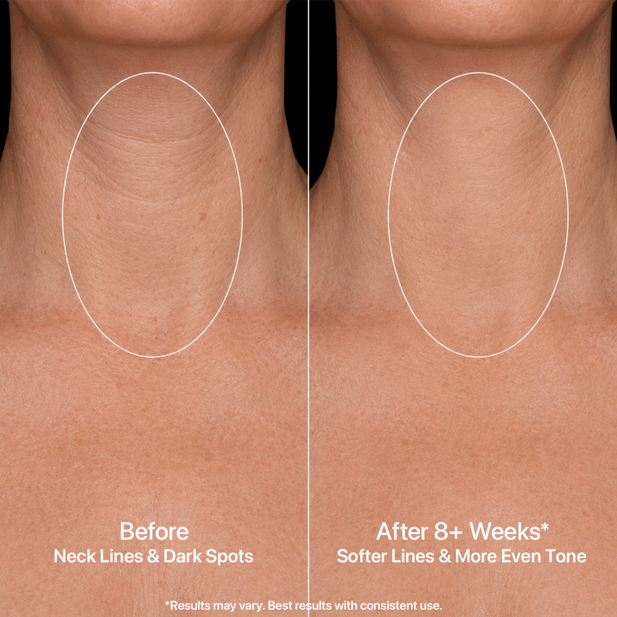 Yoeyou Pro 850nm LED Face and Neck Mask
